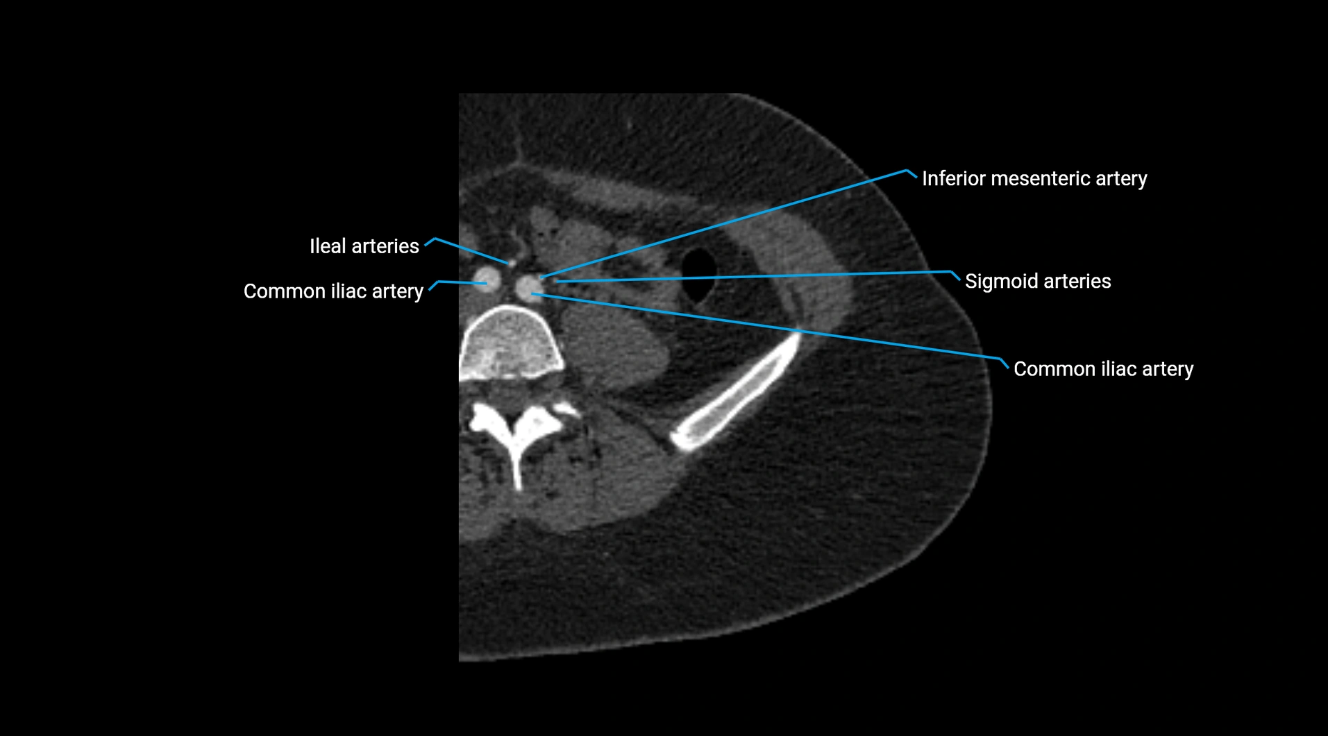 CTA lower limb cross sectional anatomy labelled image _5.webp